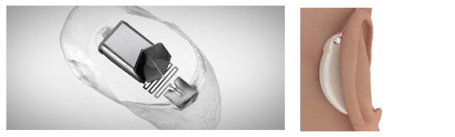 The product relies on the miniaturization made possible by flex PCB design to convert sound waves into laser signals that drive a micro-actuator inside the user’s ear, turning the user’s eardrum into a speaker.